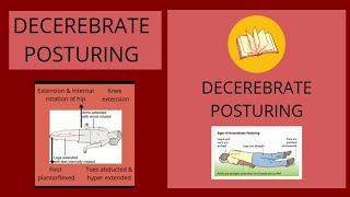 DECEREBRATE POSTUREAbnormal Posturing [upl. by Tacy]