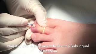 Nail Biopsy to Rule out melanoma under the nail [upl. by Hannon]