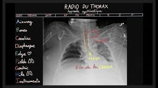 Radio du thorax  ABCDEFGHI  Partie 2  Docteur Synapse [upl. by Lladnarc]