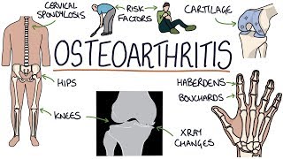 Understanding Osteoarthritis [upl. by Danais]