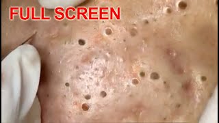 LARGE Blackheads Removal  Best Pimple Popping Videos [upl. by Aivilys]