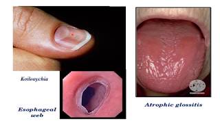 Plummer vinson syndrome [upl. by Berck741]