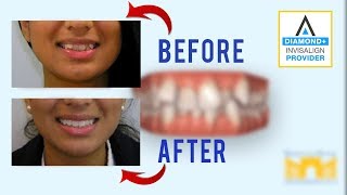 Invisalign Before and After Crowded Teeth [upl. by Whetstone]