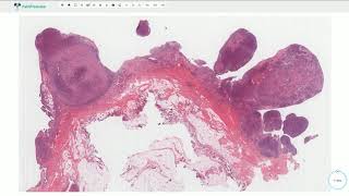 Pigmented Villonodular Synovitis  Joints Histopathology [upl. by Xed195]