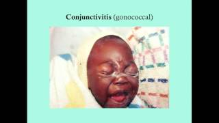 Conjunctivitis  CRASH Medical Review Series [upl. by Adelpho]