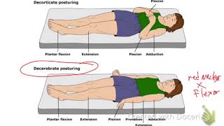 Decerebrate Vs Decorticate Posturing [upl. by Haelhsa]