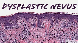 Dysplastic Nevus 5Minute Pathology Pearls [upl. by Chastity]