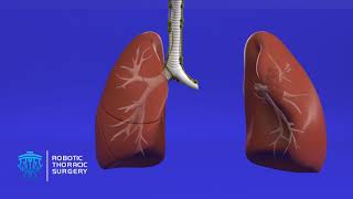 Treatment and Management of Small Cell Lung Cancer SCLC [upl. by Ackerman870]