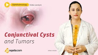 Conjunctival Cysts and Tumors  Ophthalmology Lecture  MBBS Student Study  VLearning [upl. by Nerac]