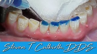 Bonding Worn Anterior Teeth  Dental Minute with Dr Steven T Cutbirth DDS [upl. by Moises]