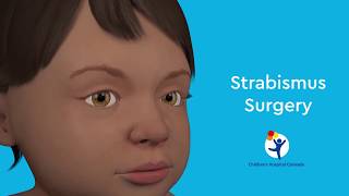 Causes and Symptoms of Strabismus [upl. by Ailev]