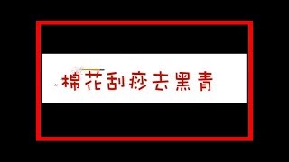 跌倒或撞到時 瘀青處理有訣竅！ [upl. by Berkie]