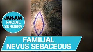 FAMILIAL NEVUS SEBACEOUS  DR TANVEER JANJUA  NEW JERSEY [upl. by Stoddard]