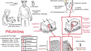 Melanoma  Overview signs and symptoms pathology risk factors treatment [upl. by Olaznog]