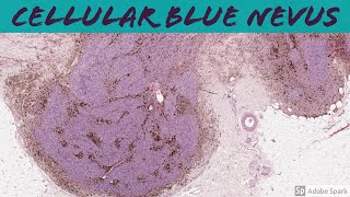 Cellular Blue Nevus 5Minute Pathology Pearls [upl. by Tedric700]