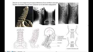 Radiographies du rachis cervical [upl. by Wahs]