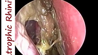 Atrophic Rhinitis Ozaena  Operated Youngs on Left amp Modified Youngs operation on Right [upl. by Adabelle528]