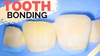 Teeth Bonding Procedure  Front Tooth Filling to Repair Chipped Tooth [upl. by Ahseryt]